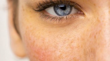 Iperpigmentazione cutanea: cause, sintomi e trattamenti
